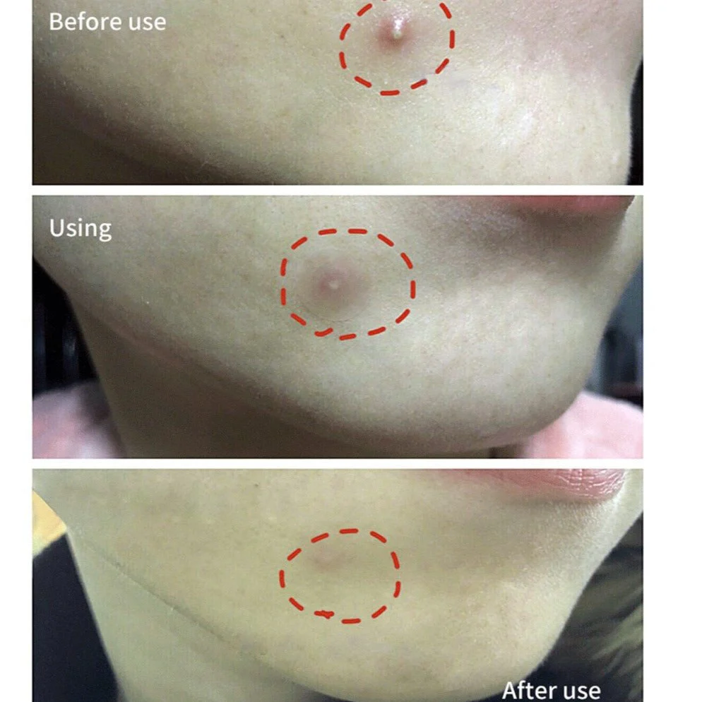 BREYLEE Acne Pimple Patch - Image 6