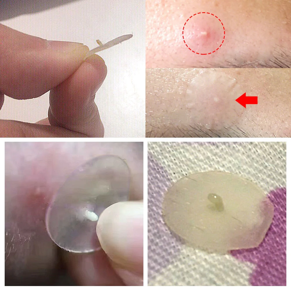 BREYLEE Acne Pimple Patch - Image 7