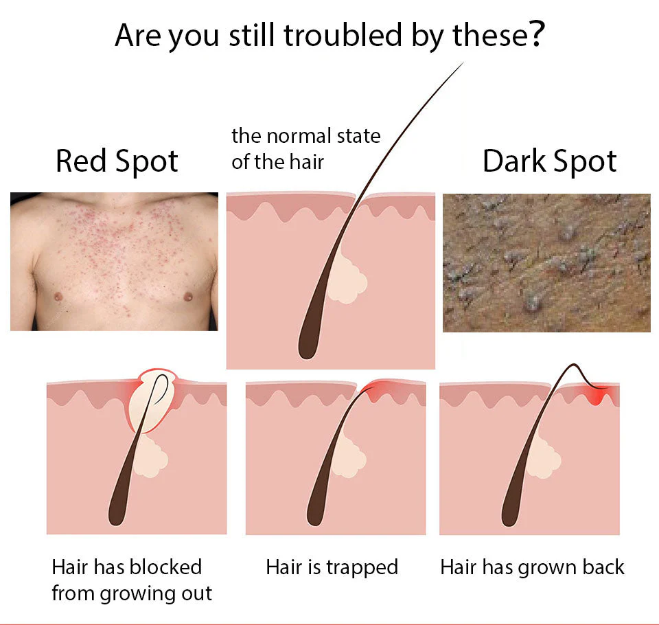 LANTHOME Razor Bump Solution for Ingrown Hair - Image 3